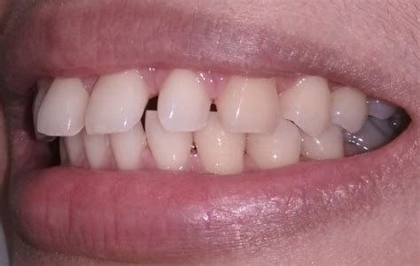 Apakah gigi tonggos bisa masuk polisi  Gigi yang tidak rata dapat dibagi menjadi beberapa kelas, yaitu : Kelas 1 ( terbanyak ) : rahang atas dan gigi sedikit lebih maju dari rahang bagian bawah, tetapi tidak timbul gangguan dalam mengatup dan juga fungsinya dalam menggigit makanan
